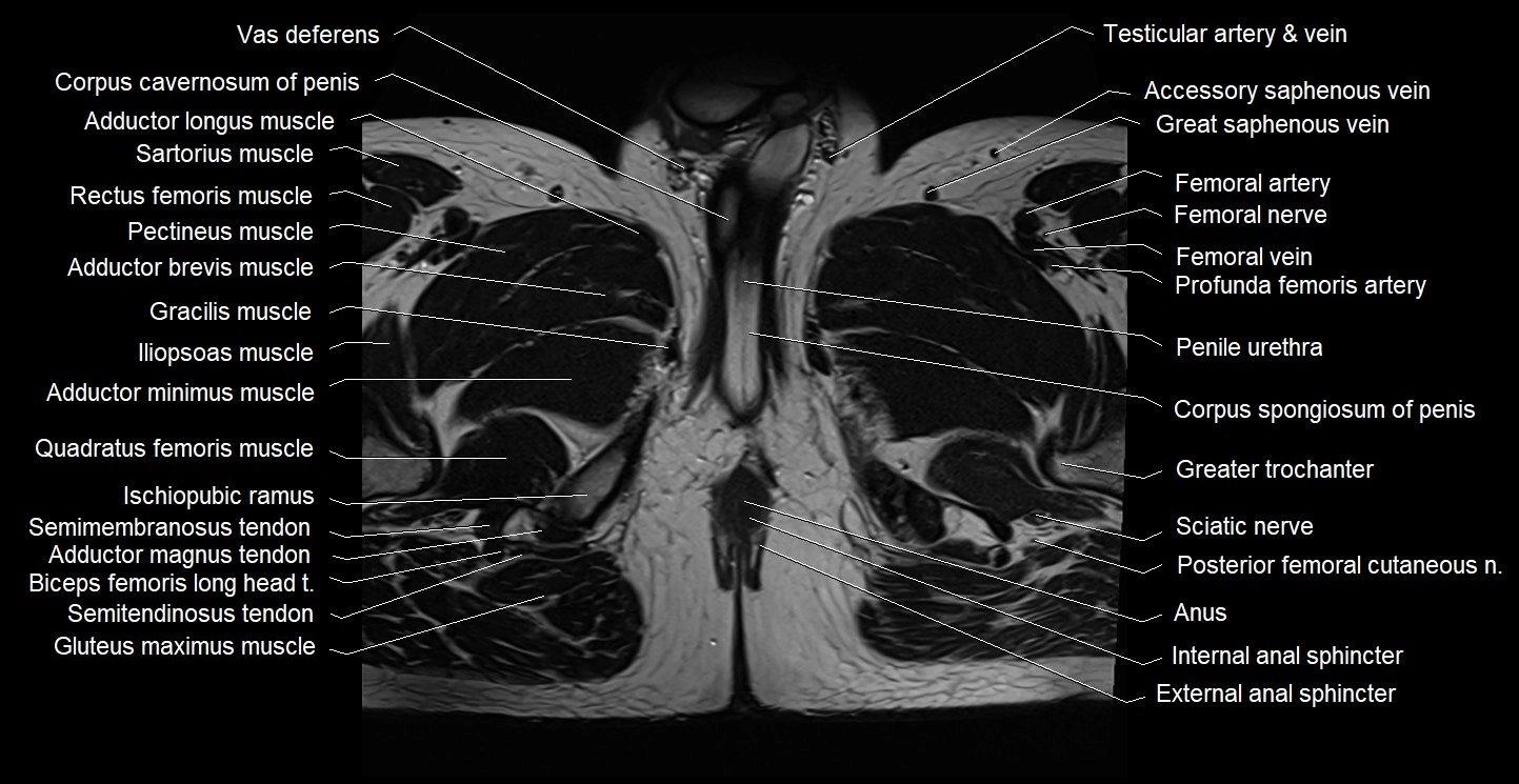 Male pelvis axial cross sectional anatomy image 46.webp